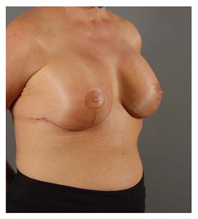 Actual patient Breast Lift with Implants procedure after photo