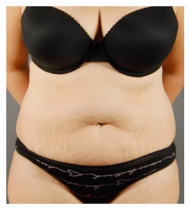 Real patient Tummy Tuck / Mommy Makeover before photo