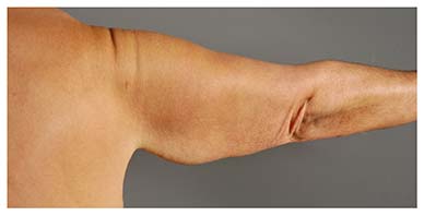 Real patient Arm Lift before procedure photo