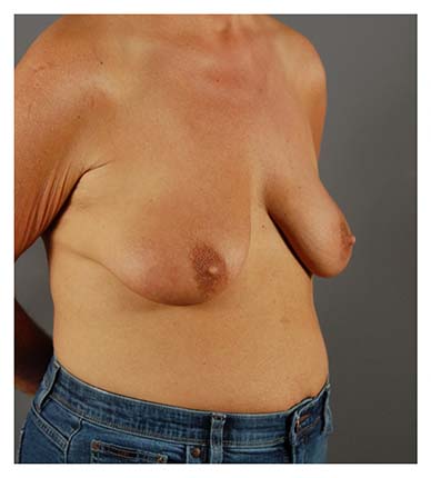 Actual patient Breast Lift with Implants procedure before photo