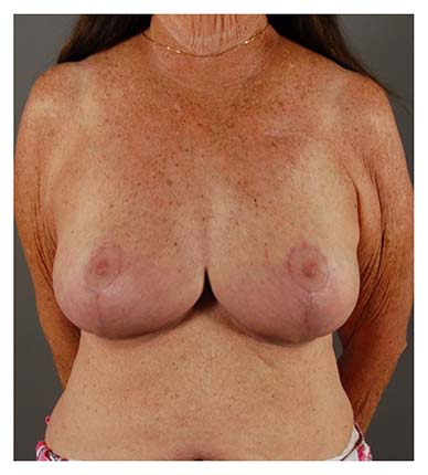 Actual patient Breast Reduction procedure after photo