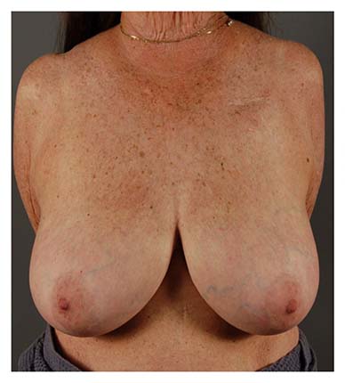 Actual patient Breast Reduction procedure before photo