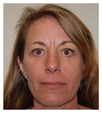 Real patient Eyelid Lift procedure after photo