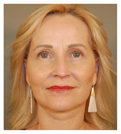 Facelift after photo