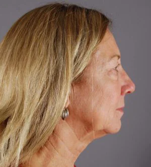 Real patient Facelift before photo
