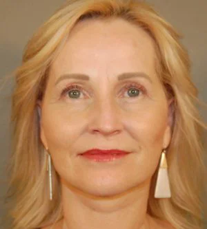 Real patient  Facelift after photo