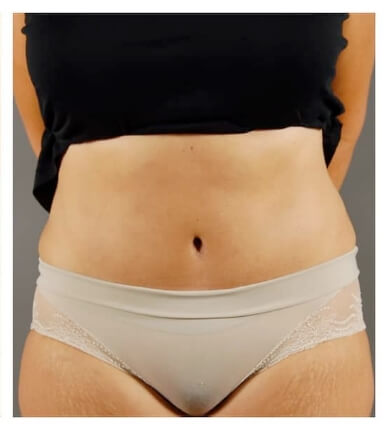 Real patient  Tummy Tuck / Mommy Makeover after photo