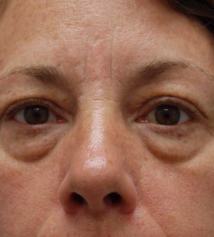 Eyelid Surgery