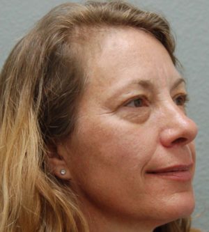 Eyelid Surgery