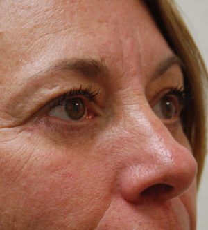 Eyelid Surgery
