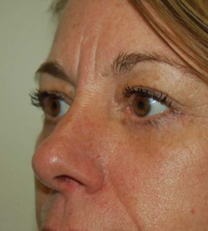 Eyelid Surgery