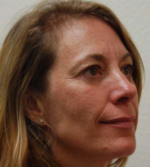 Eyelid Surgery