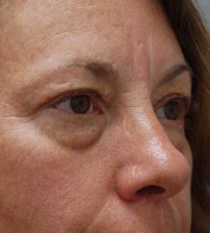 Eyelid Surgery