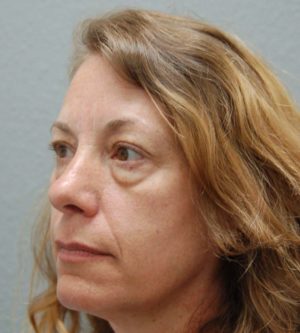 Eyelid Surgery