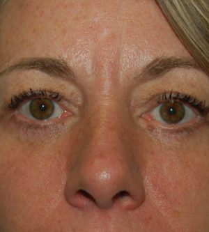 Eyelid Surgery
