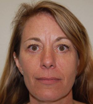Eyelid Surgery