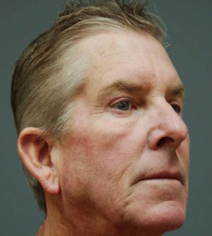 Eyelid Surgery