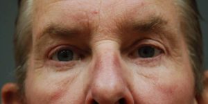 Eyelid Surgery