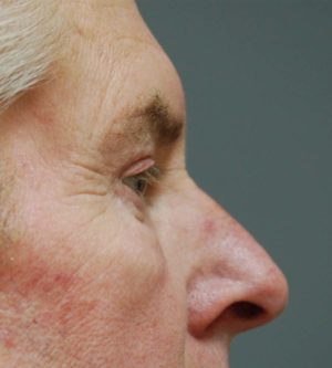 Eyelid Surgery