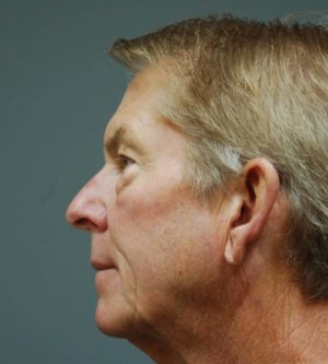 Eyelid Surgery