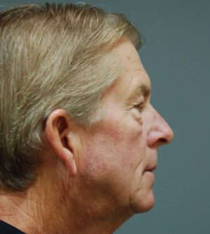 Eyelid Surgery