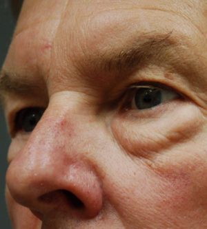 Eyelid Surgery