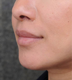 Lip Lift