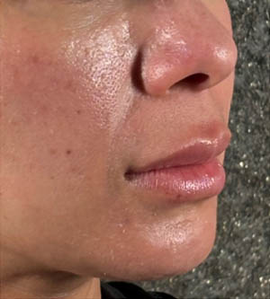 Lip Lift