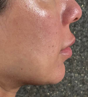 Lip Lift