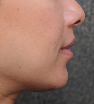 Lip Lift