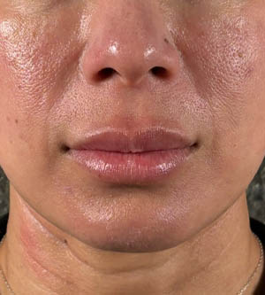 Lip Lift