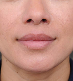 Lip Lift