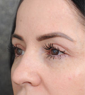 Eyelid Surgery