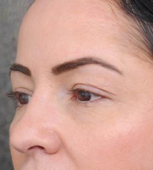 Eyelid Surgery