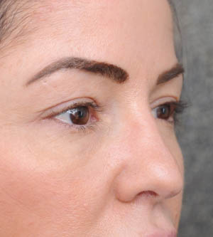 Eyelid Surgery