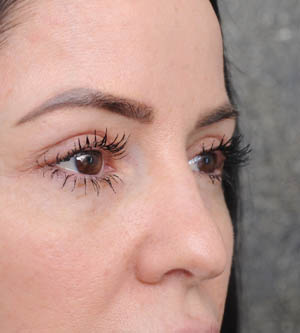 Eyelid Surgery