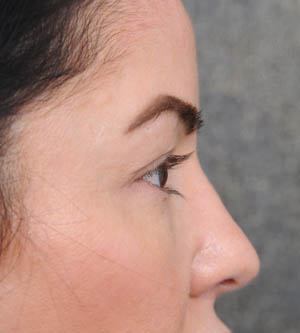 Eyelid Surgery