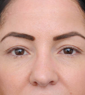 Eyelid Surgery