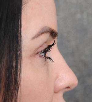 Eyelid Surgery