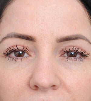 Eyelid Surgery