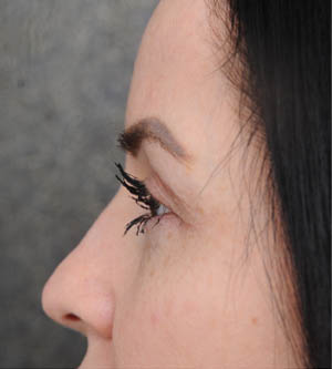 Eyelid Surgery