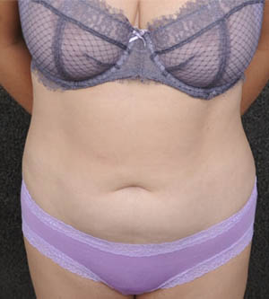 Liposuction Case 1553 Before Photo Liposuction