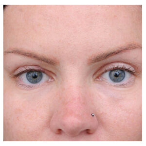 Eyelid Surgery