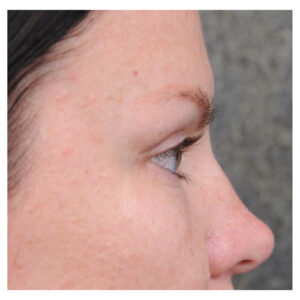 Eyelid Surgery
