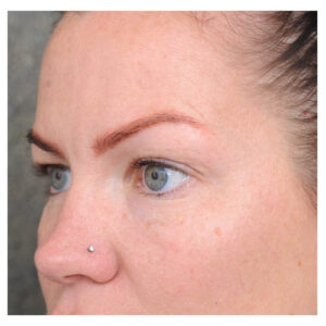 Eyelid Surgery