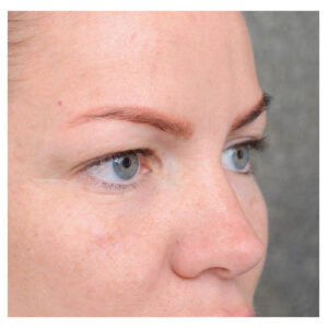 Eyelid Surgery