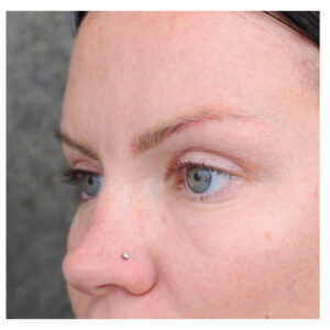 Eyelid Surgery