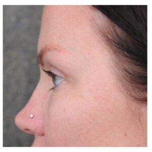 Eyelid Surgery