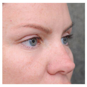 Eyelid Surgery