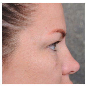 Eyelid Surgery